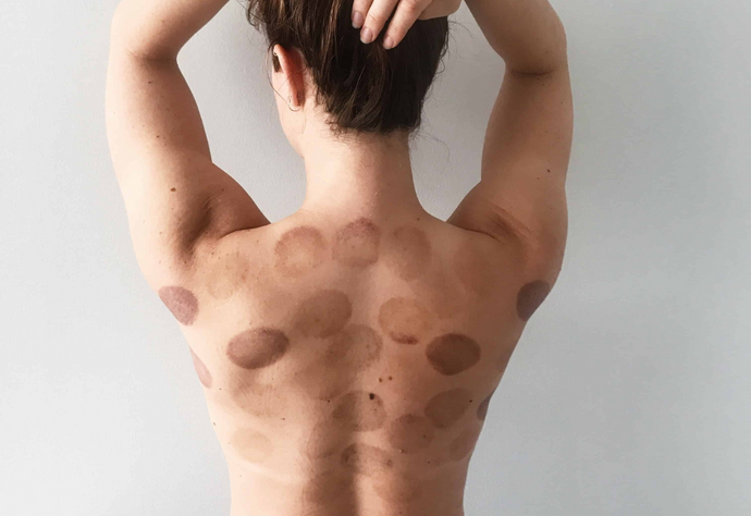 How Cupping Can Help Mental Health